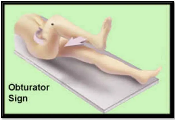 Figure 8.5. Psoas Sign