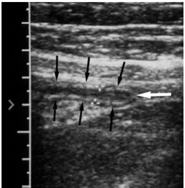 Figure 9.1. USG in acute appendicitis