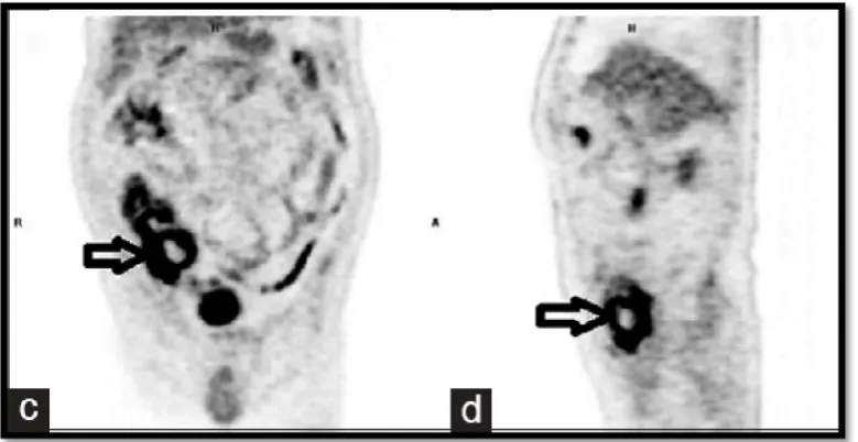 Figure 9.2. CT in acute appendicitis