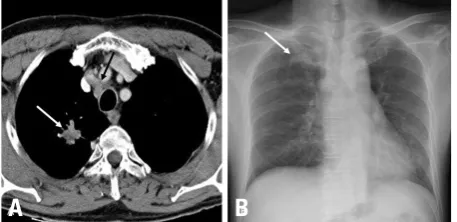 Table 5. Nineteen Malignant Tumors Detected in the Chests of VCP Patients and Side Distribution 