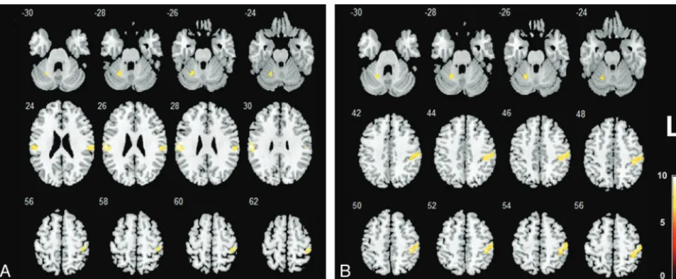 Fig 2. The hyperactive (red) and hypoactive (blue) brain regions in a patient with PD compared with the control under tactile perception (P � .005, uncorrected).