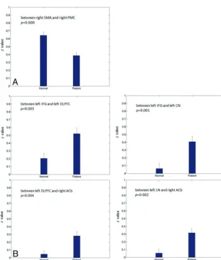 Fig 4. Reduced (A) and enhanced (B) connection strengths (z) in brain links in patients with PD compared with controls (P � .005).