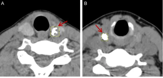 Figure 2. Typical calcified thyroid nodules. A. The goiter nodules of the left thyroid gland are associated with gross calcification