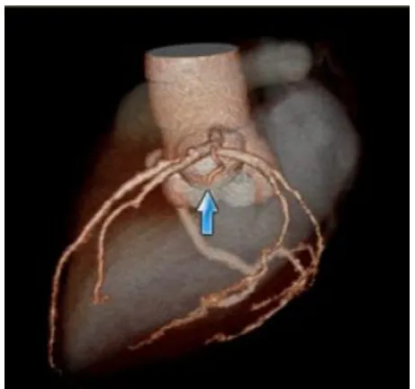 FIG 2 coronary vessels and its branches
