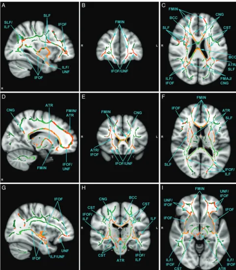 Fig 2. Selected views of affected fiber tracts with reduced FA, illustrated on MNI template brain