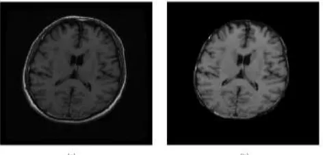 Figure 3.  (a)T1 MR image (b) Skull stripped MR image. 
