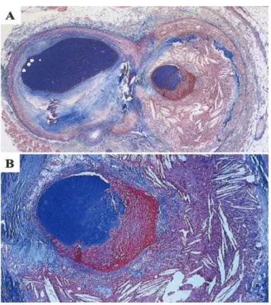 FIGURE : 2 -  (A) AND (B) ATHEROSCLEROTIC PLAQUE AND  THROMBUS FORMATION 
