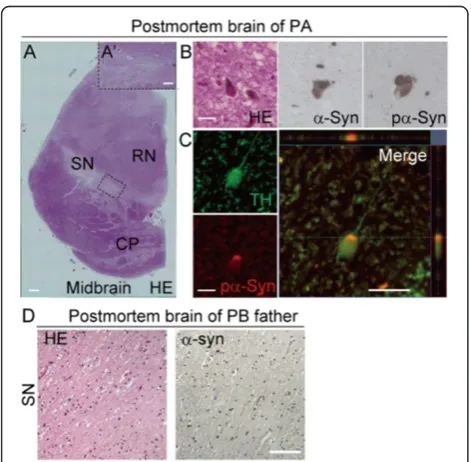 Table 2 LB type pathology in PA patient’s postmortembrain