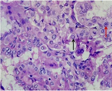 Fig.1. Papillary carcinoma of thyroid- H& E (10X)