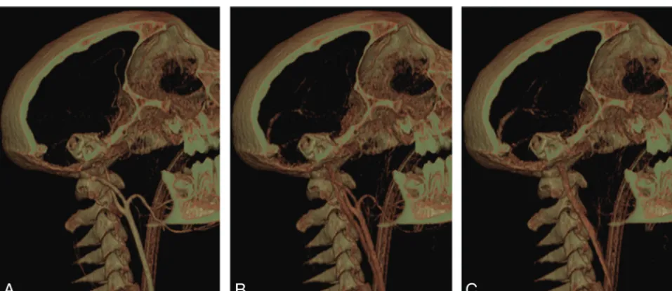 Fig 1. Zoomed-in view of the ACA (of Macaca sylvanus) at the peak of arterial opacification