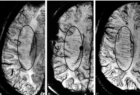 Fig 1. Representative images showing SWI stages according to the number of conspicuous DMVs draining into the subependymal veins: stage 1, mild (�5; A); stage 2, moderate (5–10;B); and stage 3, severe (�10, namely “brush like”; C).