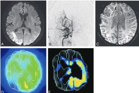 Fig 4. A, 37-year-old man showing infarction in the right occipital lobe. B, Intra-arterial angiography showing Suzuki stage 3 MMD