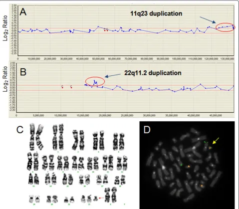 Figure 2 Array CGH with cytogenetics validation data for case 30 (Table 3). (A), (B) The array CGH results for chromosomes 11 and 22
