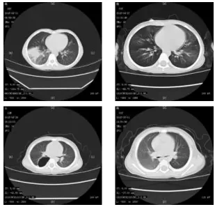TABLE I. FEATURES OF CHEST CT IMAGE. Texture feature based on gray-Shape feature based on moment 
