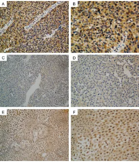 Figure 2. Representative immunostaining of CCRL2 in high-grade urothelial carcinoma samples (A, B), low-grade urothelial carcinoma samples (C, D), and isotype matched negative samples (E, F)