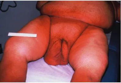 Figure 2: The appearance of the scrotum after tracheostomy anddiuresis. The patient was able to ambulate.