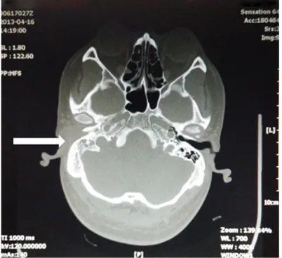 Figure 1. Computed tomography (CT) revealed the complete obstruction of right external auditory canal and absence of the normal mastoid air cells.