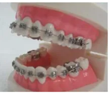 Figure 2. Use metal braces to correct the teeth.  