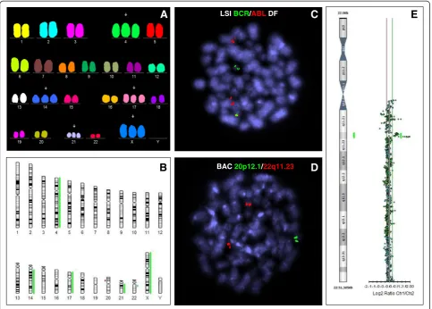Figure 1 Results of molecular cytogenetic analysis. Multicolor FISH (A) and array CGH (B) showing trisomies of chromosomes X, 4, 14, 17 and21 (A, B) and submicroscopic aberrations: deletion of chromosome 20 and amplification of chromosome 22 (B)