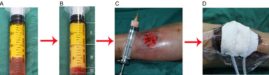 Figure 1. Schematic diagram of treatment with high-density nanofat grafting combined with NPWT for chronic wounds