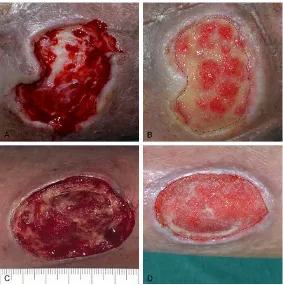 Figure 2. Wound changes after high-density nanofat grafting combined with NPWT. Patient 1: (A) A chronic left leg wound with an original area of 8.89 cm2