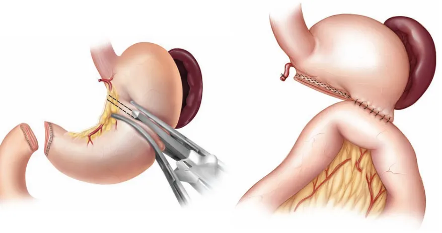 Fig 1. Distal Gastrectomy with Gastrojejunostomy
