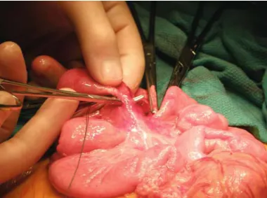 Fig 2. Small bowel resection -  -Mesentric Vessel Ligation
