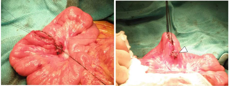 Fig 3. Small bowel resection and anastomises