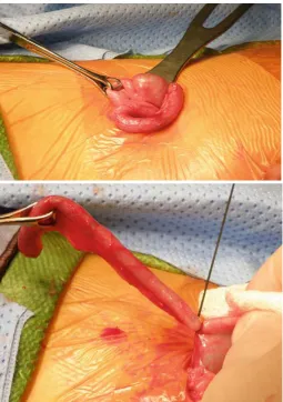 Fig 4. Appendicectomy