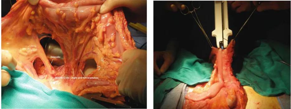 Fig 5. Right Hemicolectomy