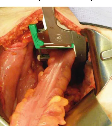 Fig 6. Sigmoid Colectomy
