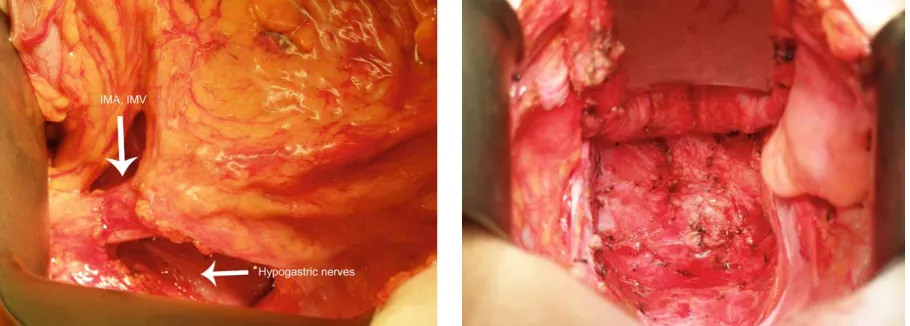 Fig 7. Total Mesorectal Excision