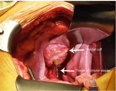 Fig 8. Low Anterior Resection