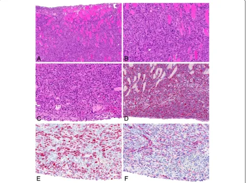 Figure 5 Sarcomatoid-type malignant mesothelioma observed in the MWCNT B high-dose group
