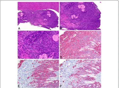 Figure 7 Biphasic-type malignant mesothelioma observed in the amosite asbestos group. A: H & E, low magnification of tumor tissuefound on the liver surface (10×)