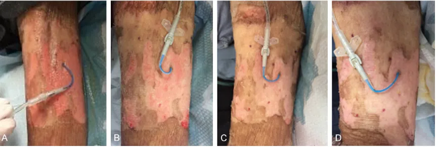 Figure 4. Dermlin cream (A) was rubbed into the vaseline gauze with a small 0.5 cm incision on the side (B)
