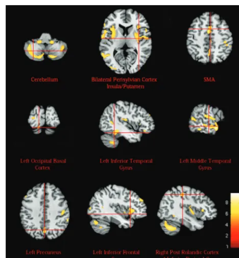 Table 2: GM regions significantly reduced (P < .05 FDR corrected) in the autistic group by comparison with the controls