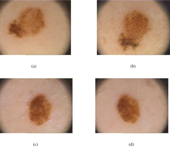 Figure 3.1: Two pairs of dermoscopy images from two different lesions: 3.1a and 3.1b refer to the evolution of a malignant lesion; 3.1c and 3.1d refer a benign lesion in two different moments.