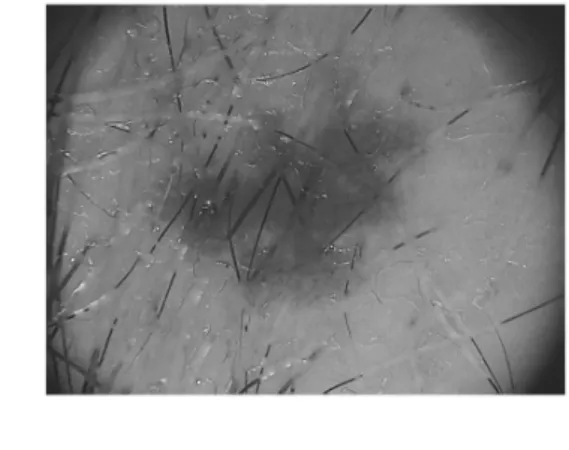 Figure 3.3: Application of inpainting algorithm: a) original dermoscopy image of a melanoma and b) corresponding image after this technique.
