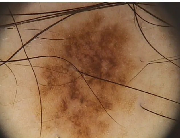 Figure 4.4: Dermoscopy image of a malignant lesion with an atypical pigment network