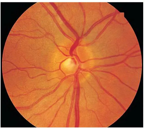 Fig  1. Papillitis – marked inflammation of the optic disc 