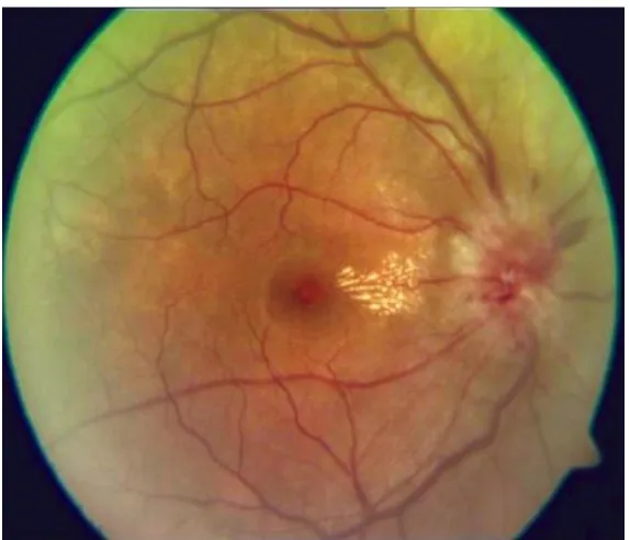 Fig 3  Neuroretinitis-  marked inflammation around the optic disc with involvement of adjoining retina 