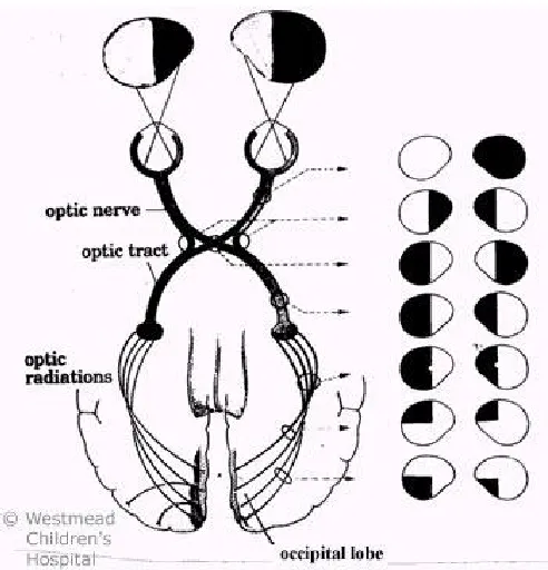 FIGURE :  1.1 Lesions along the optic pathways showing visual field 