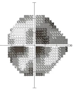 Figure 1.2: Humphrey visual field analysis  showing diffuse loss of 