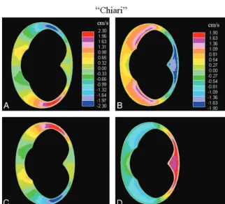 Fig 3. Axial sections show flow velocity at the craniovertebral junction in the Chiari model at the time when caudal volume flow rate is maximal (t � 0.25 seconds)