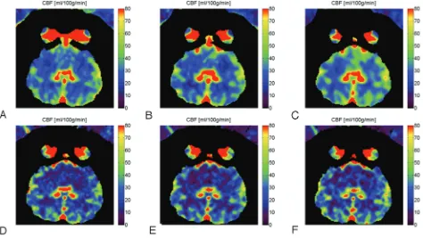 Fig 2. CBF maps for 6-scan sets (A-B-C-D-E-F) from different injection-protocol C-arm CBCT (mL/s 50% (A�C) and CTP images (D�F)