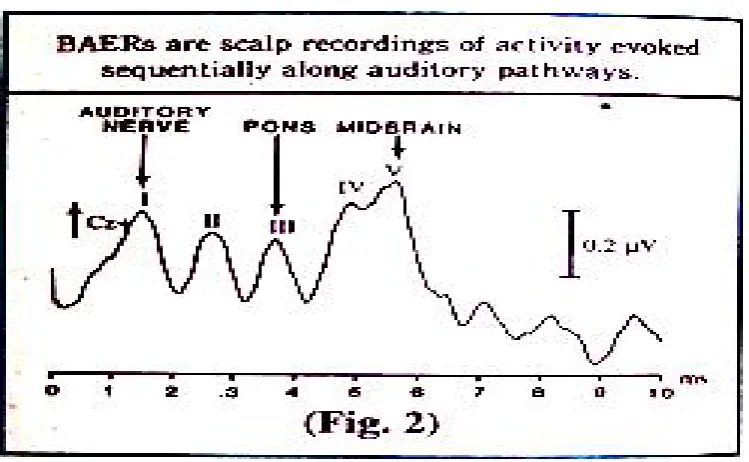 Fig. - 5 Normal Auditory Evoked Potential Wave Pattern
