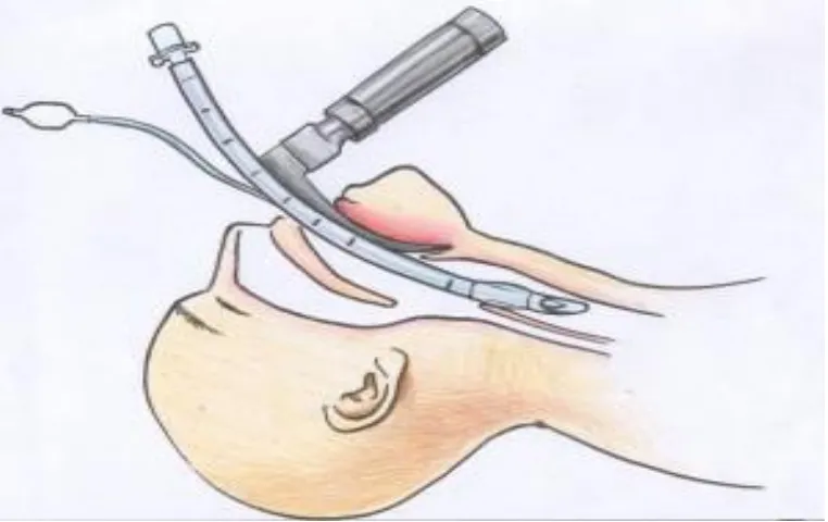 Fig.1: Method of endotracheal intubation by direct laryngoscopy. 