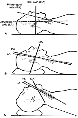 Fig.2: Position for endotracheal intubation. 