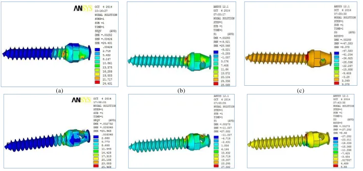 Fig-16: Stress plot showing (a) Vonmises (b) Maximum Principal (c) Minimum Principal stress between  Group-I (Top Panel) and Group-II (Lower Panel) in mini screw with Pitch of the mini screw as variable 
